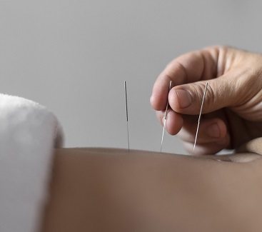 acupuncture